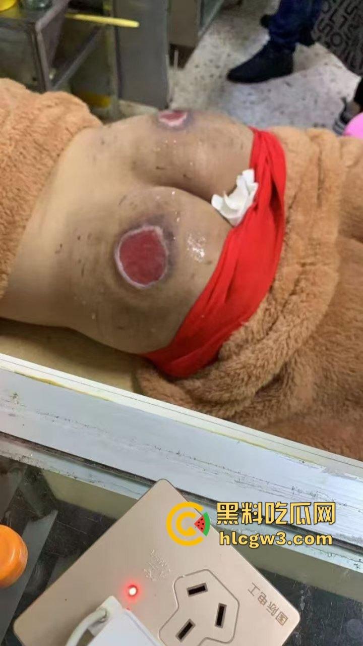 缅北电诈猪仔【陈锦和】失联4个月终获救 屁股惨遭电刑割肉伤疤惨不忍睹 真是炼狱一日游!-8